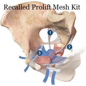 prolift mesh kit